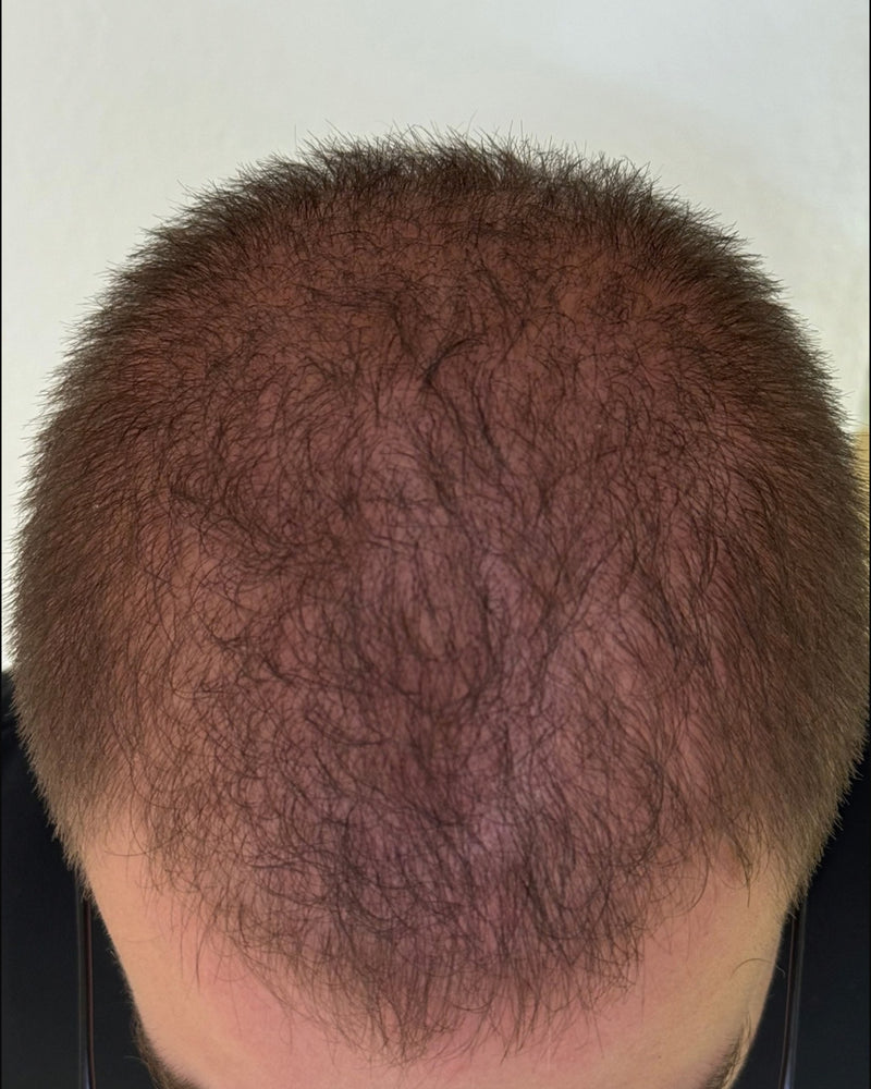 After 6 months of using R&DETAIL Scalp Activating Lotion