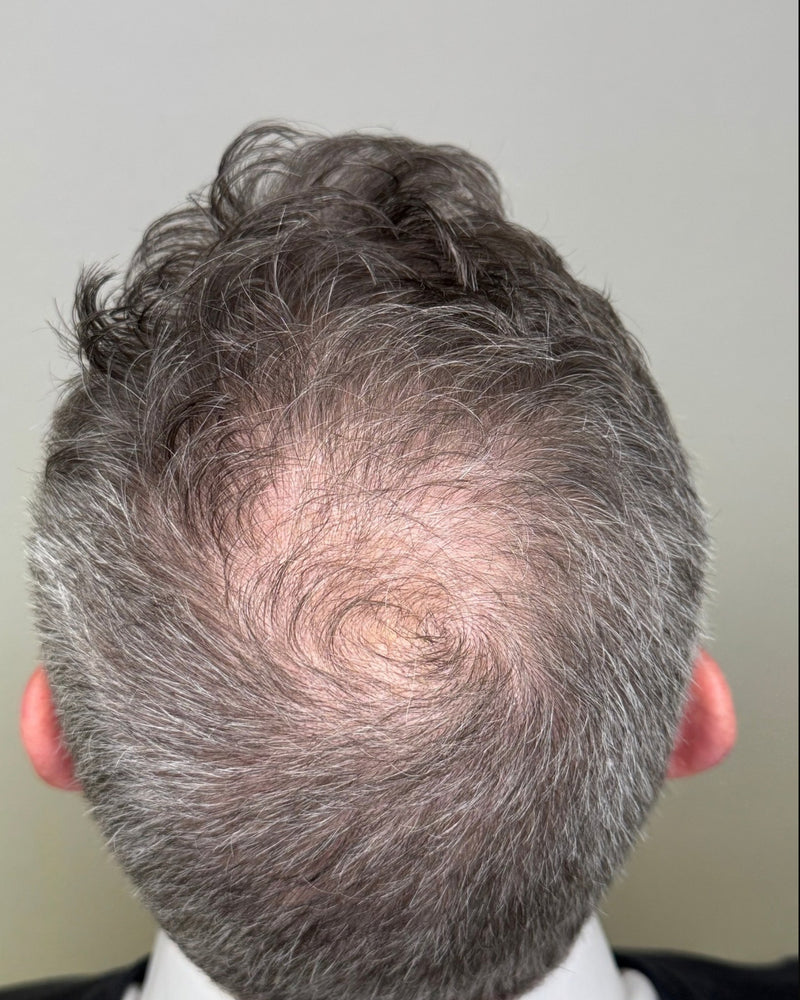 Before using R&DETAIL Scalp Activating Lotion, thinning crown