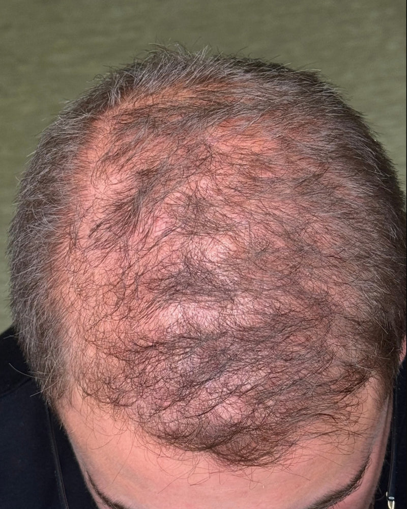 Before using R&DETAIL Scalp Activating Lotion, thinning hair