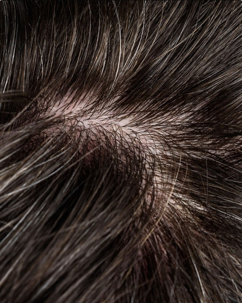 Scalp close-up, after