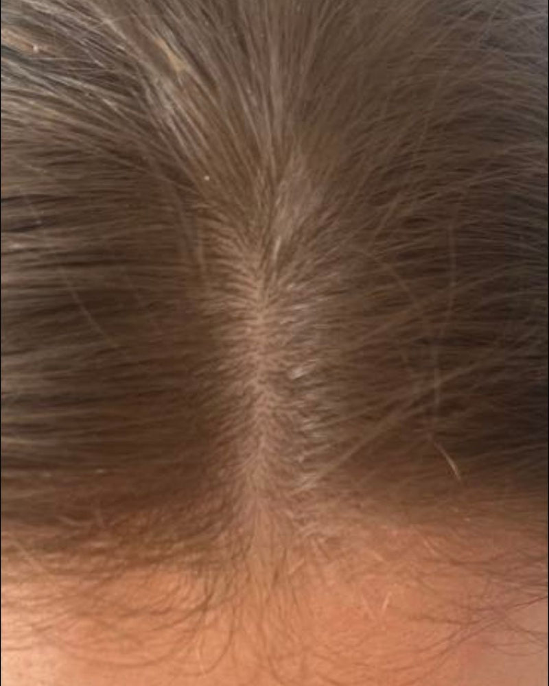 Scalp close-up, after